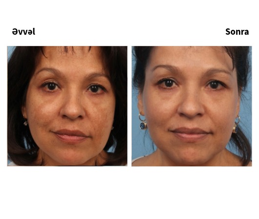 Lutronic Hollywood Spectra